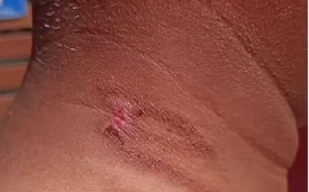 സംസ്ഥാനത്ത് ചൂട് കൂടുന്നു; മൂന്ന് പേര്‍ക്ക് സൂര്യാതപമേറ്റു 