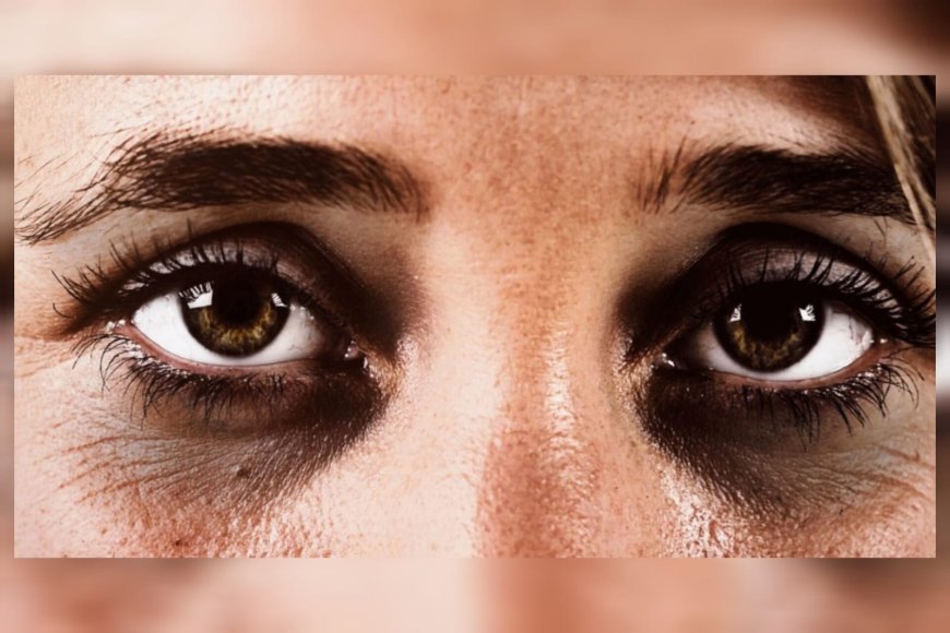 കണ്ണിന് താഴെയുള്ള കറുപ്പ് വെറും ഉറക്കക്കുറവല്ല; അവഗണിക്കരുതെന്ന് ആരോഗ്യ വിദഗ്ധർ