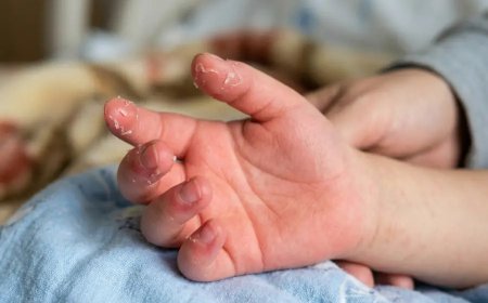 കട്ടപ്പനയിൽ ഒന്നര വയസ്സുകാരിക്ക് അപൂർവമായ 'കവാസാക്കി' രോഗം; കൃത്യസമയത്തെ രോഗനിർണ്ണയം ജീവൻ രക്ഷിച്ചു