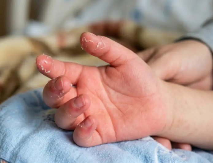 കട്ടപ്പനയിൽ ഒന്നര വയസ്സുകാരിക്ക് അപൂർവമായ 'കവാസാക്കി' രോഗം; കൃത്യസമയത്തെ രോഗനിർണ്ണയം ജീവൻ രക്ഷിച്ചു