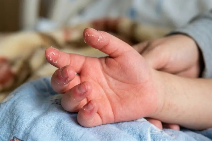 കട്ടപ്പനയിൽ ഒന്നര വയസ്സുകാരിക്ക് അപൂർവമായ 'കവാസാക്കി' രോഗം; കൃത്യസമയത്തെ രോഗനിർണ്ണയം ജീവൻ രക്ഷിച്ചു